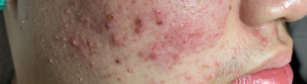 best acne treatment bangkok